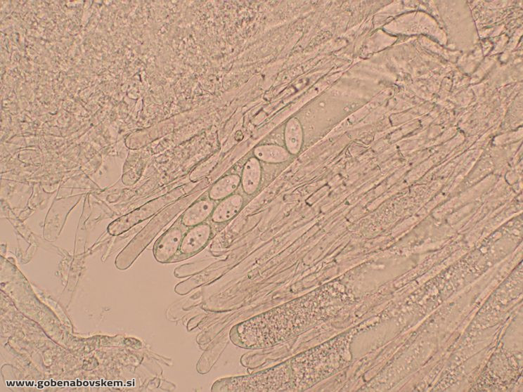 DISCIOTIS VENOSA UŠJE 17 3 26 3